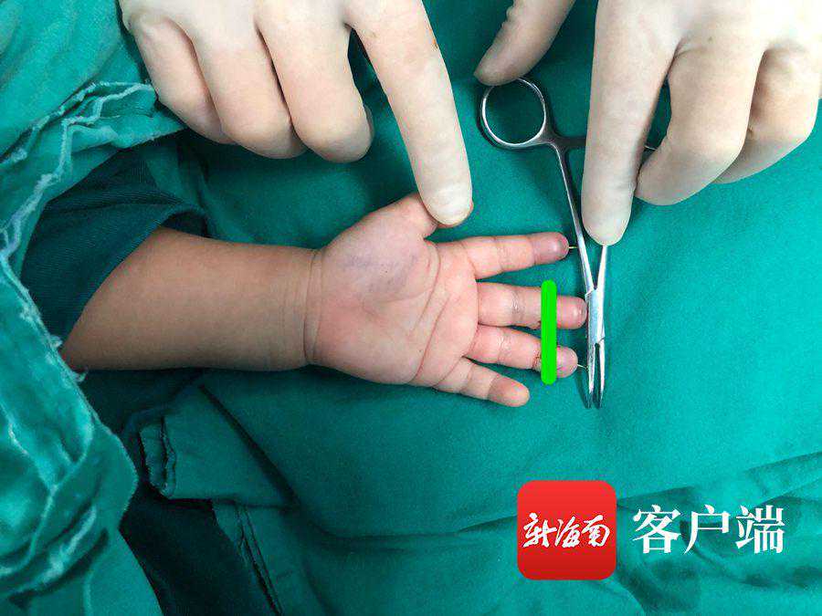 又是它！陵水一岁多男幼童被奶茶封口机切断三指……