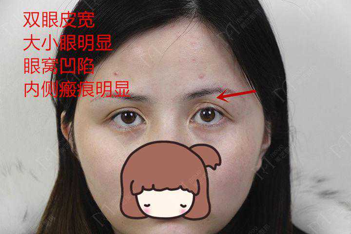 刻意包装的双眼皮不要轻信，做双眼皮前还需认真地做下功课呀